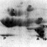 Two-dimensional electrophoresis gel