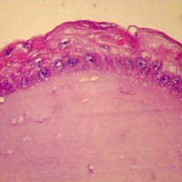 implantation of a epidermis fragment