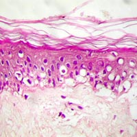 epithelial alteration