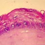 Epidermisation