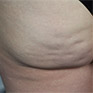 Evaluation of cellulite