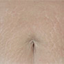 Evaluation of stretch marks