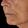 Increased skin homogeneity visualised in 3D